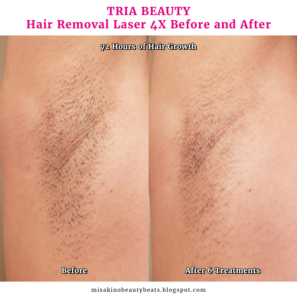 TRIA hair removal laser - ボディケア